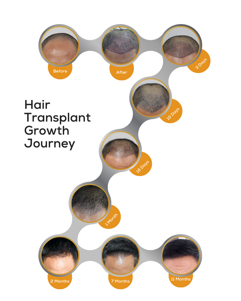 Hair Transplant Growth Journey